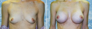 Breast Augmentation                   